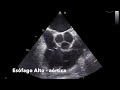 Vídeo 18.5 - Esôfago alto valva aórtica