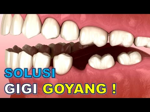 SOLUSI GIGI GOYANG: splinting gigi ‼️