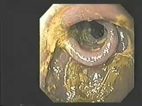 How To Remove Mucoid Plaque Naturally How To Remove Mucoid Plaque Naturally
