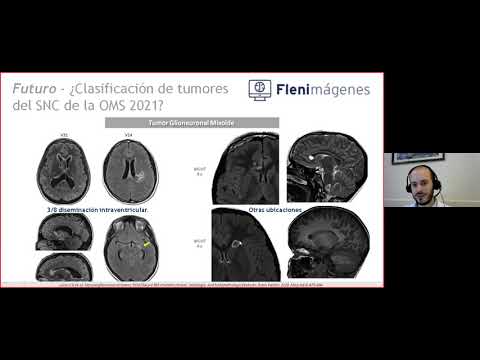 Vídeo: Alteraciones De La Familia De Genes FGFR En Tumores Neuroepiteliales De Bajo Grado