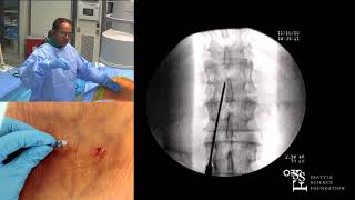 Lumbar Spinal Cord Stimulation Trial  Ramana Naidu, MD