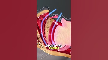 Causes And Treatment Of Snoring {3D Animation)  #sleepapneaawareness #Snoring