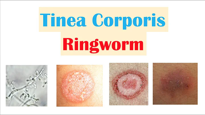 Ringworm (Tinea Corporis) | Causes, Risk Factors, ...