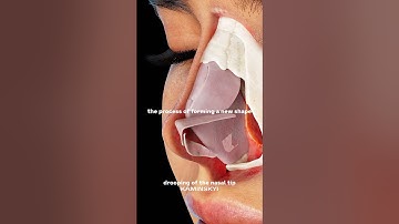 Why then tip drops after rhinoplasty  ⭕️  #kaminskyi