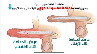 كيف يحدث الانتصاب بعد عملية دعامة العضو الذكري