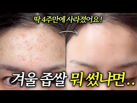 지긋지긋한 여드름, 집에서 빠르게 없애는 법!