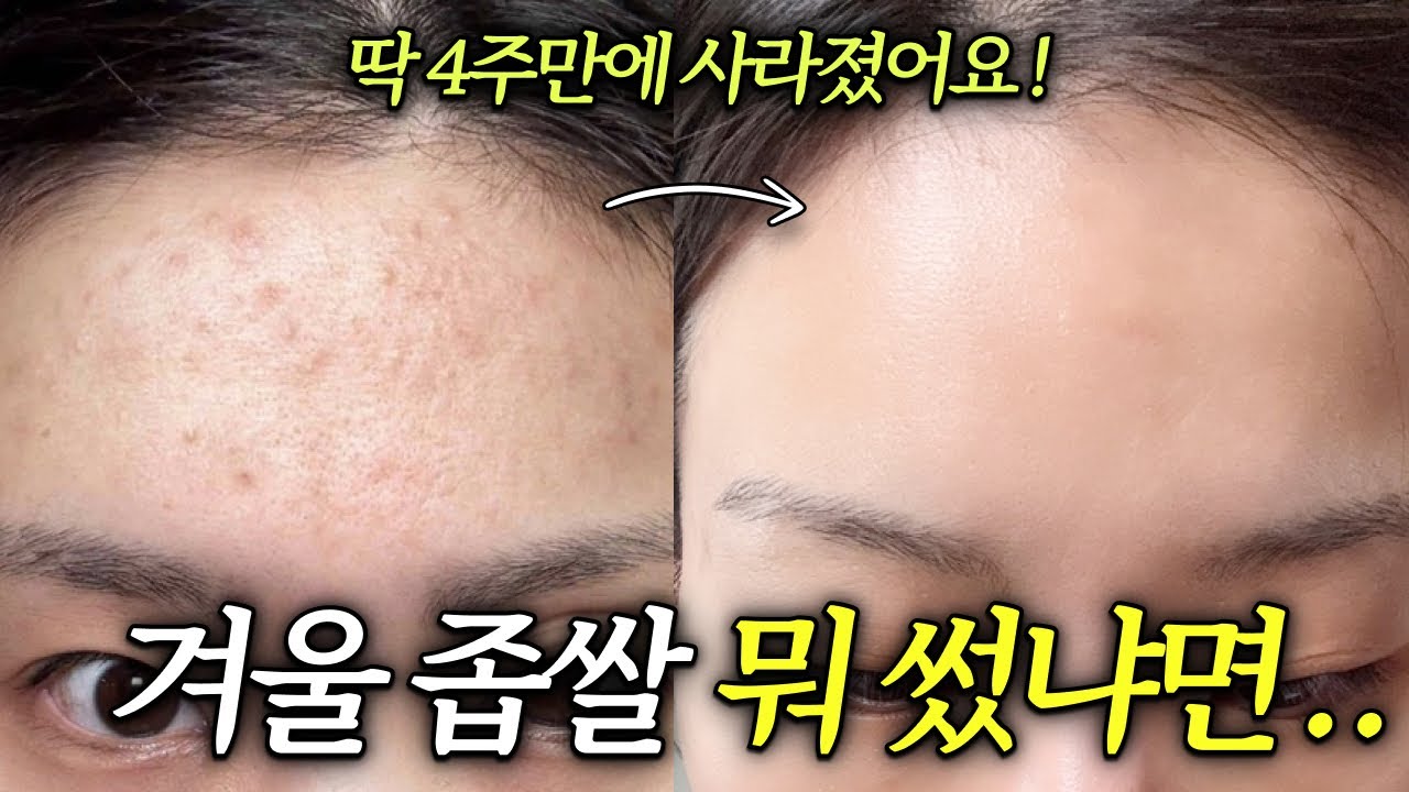 지긋지긋한 여드름, 집에서 빠르게 없애는 법!