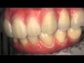 Biohpp eplant bredent beever dental screw retained