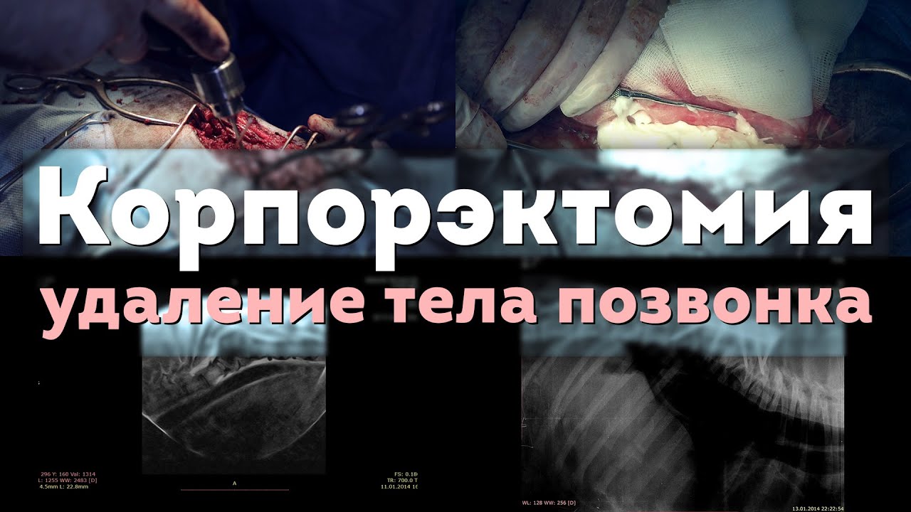 Корпорэктомия. Corpectomy - YouTube