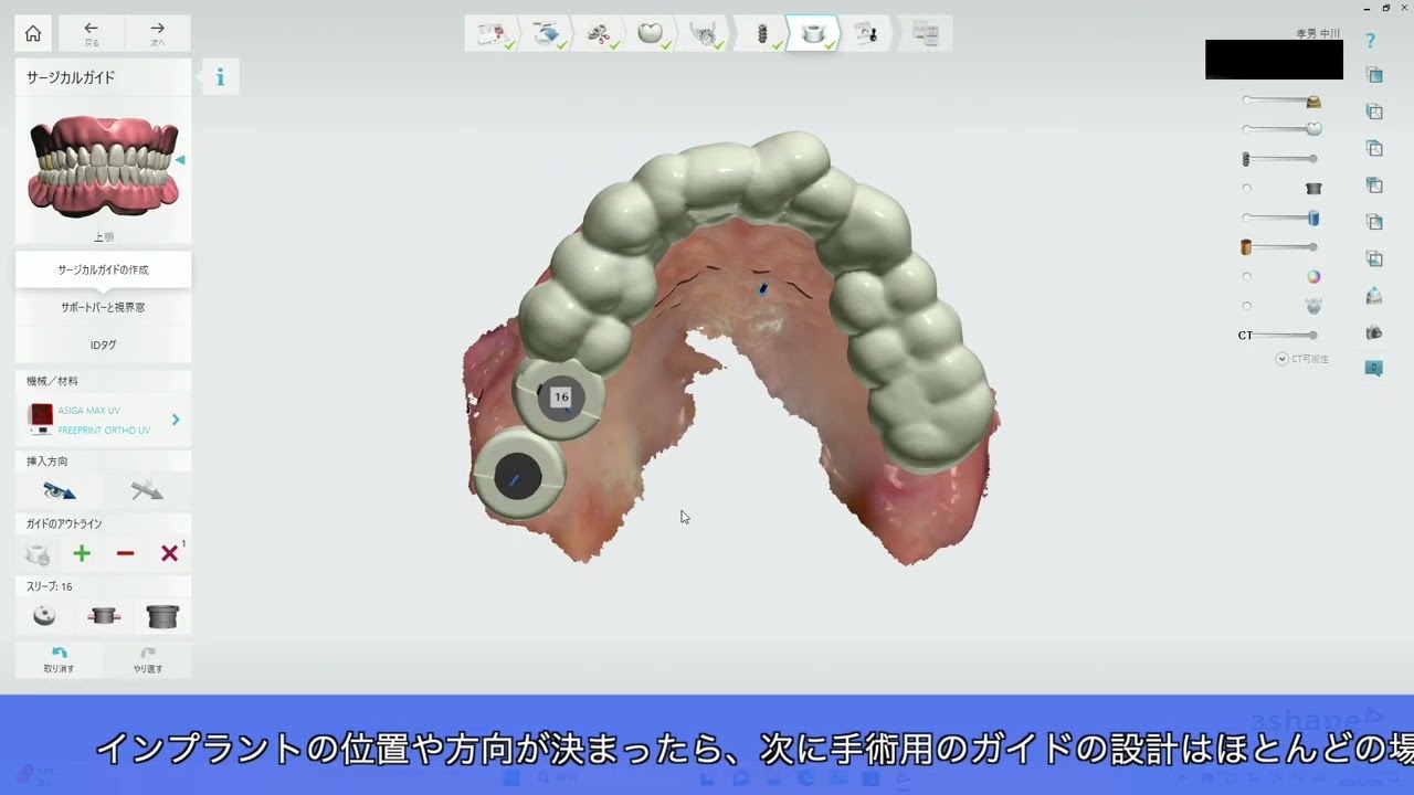 インプラント｜表参道 中川歯科クリニック