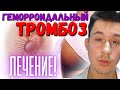 Геморрой/ Геморроидальный тромбоз. Лечение