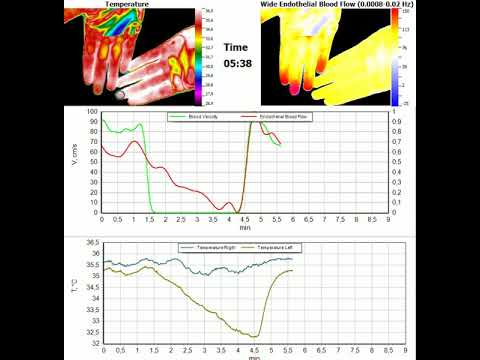 Термовизуализация гемодинамики с контролем скорости кровотока.
