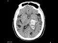 Acute stroke by Dr Gireesh Kumar KP