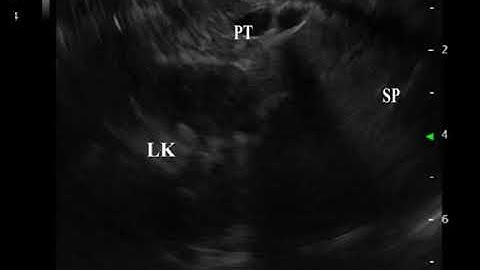 Video 7 Scanning Pancreas and Pancreatic Duct from the Stomach