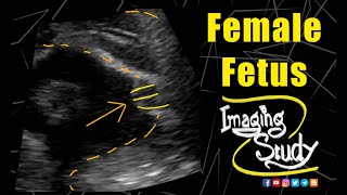 Female Fetus - 28th Week - Breech Presentation || Ultrasound || Case 165