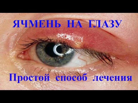 Ячмень на глазу | Простой способ лечения.