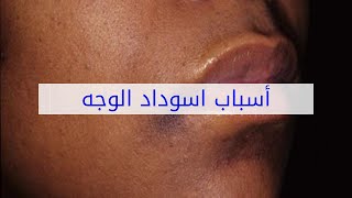 أسباب اسوداد الوجه