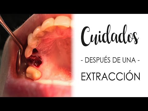 infeccion despues de extraccion muela del juicio infeccion despues de extraccion muela del juicio