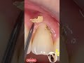 #satisfying #teethdecay ASMR Deep Teeth Cleaning #tartar #dental #viral