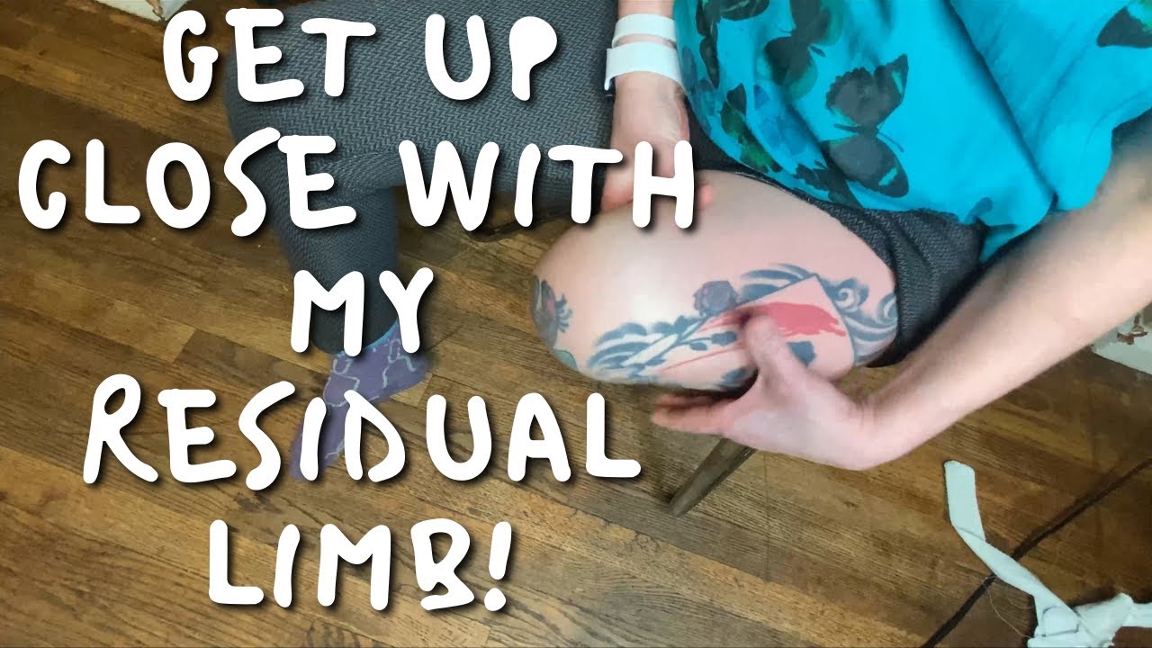 Up close and personal with an AK residual limb (pre-revision