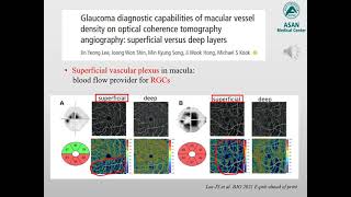 Relevance of ocular circulation in glaucoma-OCT angiography study？