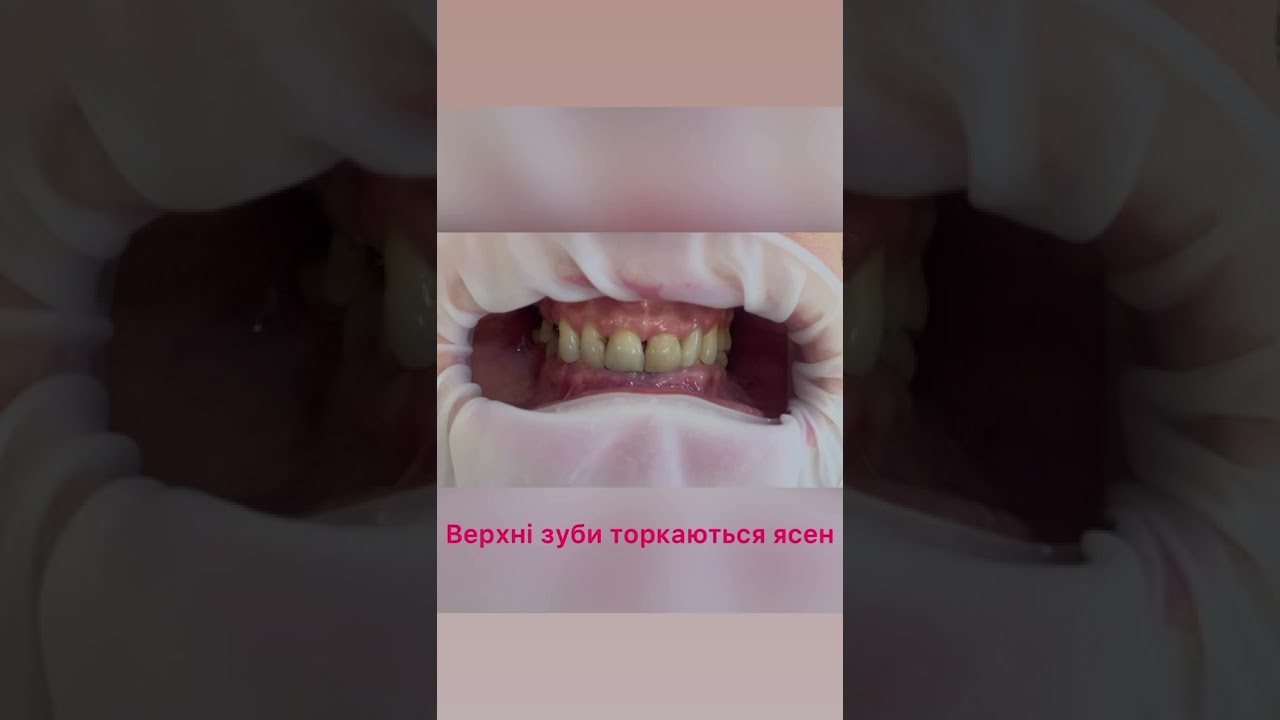 Циркониевые коронки - биосовместимость, надежные и доступные в стоматологии Днепр брамадент