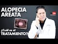 Alopecia areata.Tratamiento | Dr. Marino dermatólogo