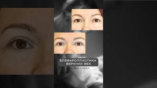 ДО и ПОСЛЕ у пластического хирурга Ли Александра #shorts #блефаропластика #пластическийхирург