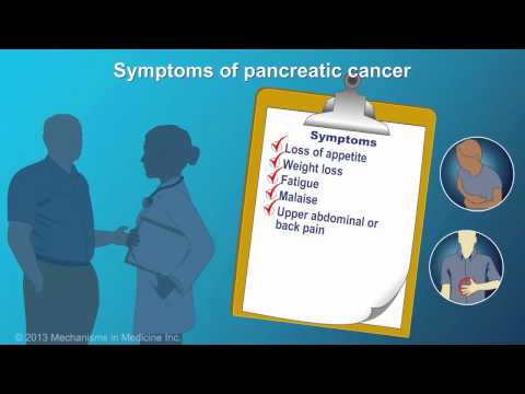 Pancreatic Cancer: Signs, Symptoms and Risk Factors