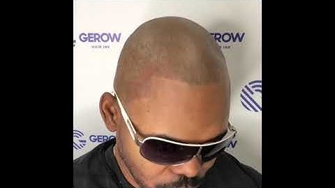 The truth behind ScalpMicropigmentation (Hair Tattoo)?