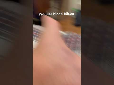 Video: Blister Gənə Zərərvericiləri – Meyvə Ağaclarında Blister Gənələrlə Necə Mübarizə Olunur
