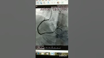 PCI TO RCA/ Angioplasty/ #shorts #pci #rca #medical #doctor #hart