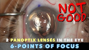 FIXING a poor result AFTER Cataract Surgery | 2 Panoptix Lenses in the SAME EYE | IOL Exchange