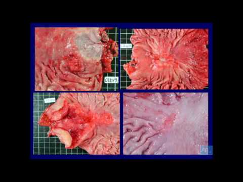 Vidéo: L'analyse De Survie Et Les Effets Oncogènes De L'expression De CFP1 Et 14-3-3 Sur Le Cancer Gastrique