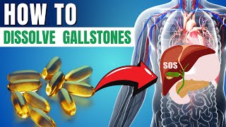 5 Vitamins That Can Help Dissolve Gallstones