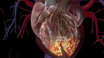 Learn about cardiac pacemaker and defibrillator