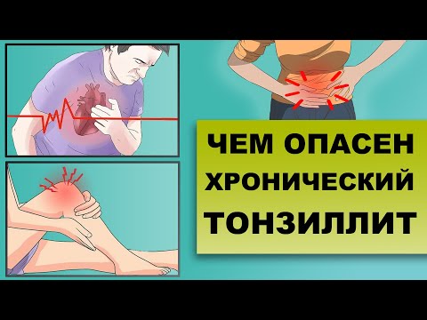 ЧЕМ ОПАСЕН ХРОНИЧЕСКИЙ