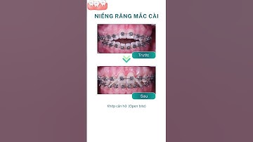 Niềng răng mắc cài điều trị khớp cắn hở