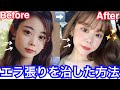 小顔になって垢抜けした方法！美容医療★エラボトックスについて...♫