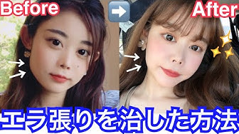 エラボトックス Youtube