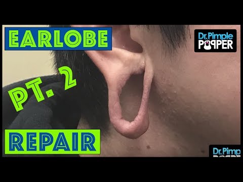 Earlobe Repair After Significant Stretching: Pt.2