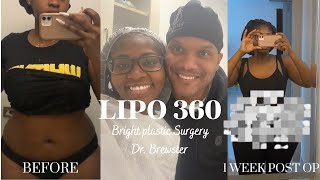 LIPO 360 SURGERY VLOG PT 2 | DR.BREWSTER 🦋 | 305 BRIGHT PLASTIC SURGERY