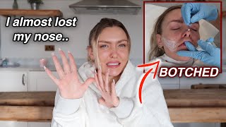 How I almost Lost my Nose from Cosmetic Surgery.. (A Horror Story)