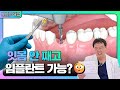임플란트 절개 vs 비절개 차이·장단점 총정리 | 비절개 임플란트 가능한 조건 #화이트이치과 #덕천치과