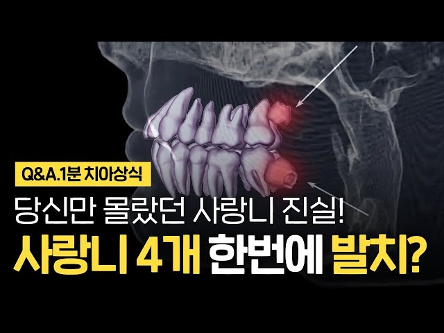 사랑니발치 한 번에 4개 동시에 빼도 되나요?