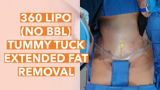 Amazing Transformation: 360 Liposuction (No BBL) Extended Fat Removal with Tummy Tuck!