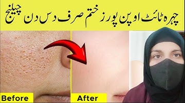 ‎Open Pores Treatment | Tighten Skin Naturally | What Doctors Don’t Tell You‎