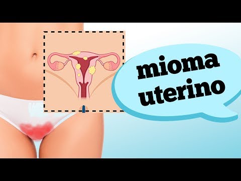 MIOMA NO ÚTERO: QUANDO SE PREOCUPAR?