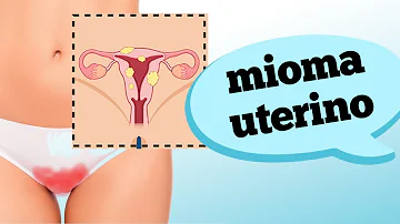 Quais os sintomas do mioma no útero?