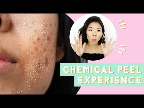 ✂ Chemical Peel for Acne & Scars: Before & After